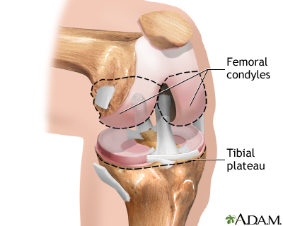 Knee joint replacement  - series - Illustration Thumbnail
              