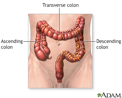 Large bowel resection  - series - Illustration Thumbnail
              