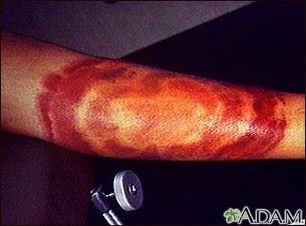 Lyme disease - erythema migrans