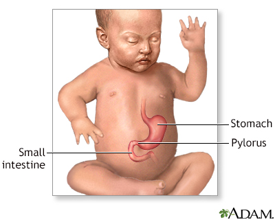 Infantile pyloric stenosis - series - Presentation Thumbnail              