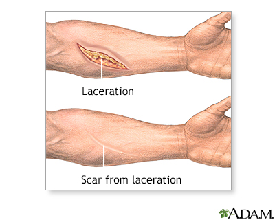 kidney transplant scar healed