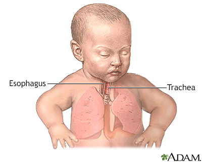 esophageal atresia repair