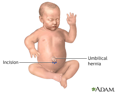 Umbilical hernia repair (child)