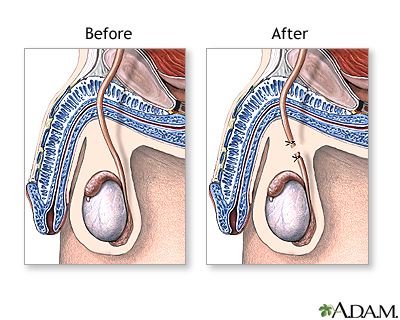 Vasectomy - Treatments Urology Associates