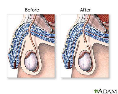 HIE Multimedia - Vasectomy