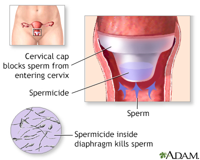 Birth Control Barrier methods of birth control series