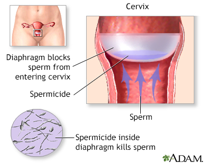 Birth Control Barrier methods of birth control series