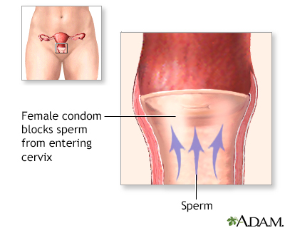 Female Condom