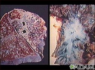 Tuberculosis in the lung - Illustration Thumbnail
              