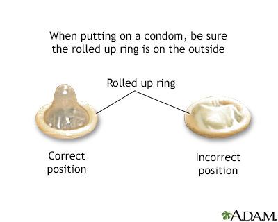 How to Use a Condom Correctly