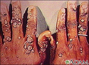 black warts on hands