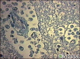 Amebic brain abscess - Illustration Thumbnail
                      