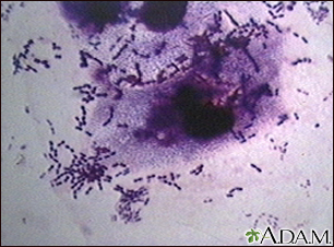 streptococcus pneumoniae gram stain csf