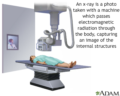 Paget Disease of the Bone