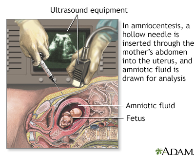 amniocentesis results