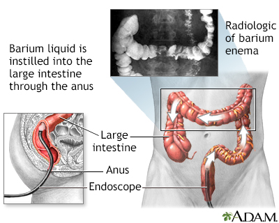 Colon Cancer Information Mount Sinai New York