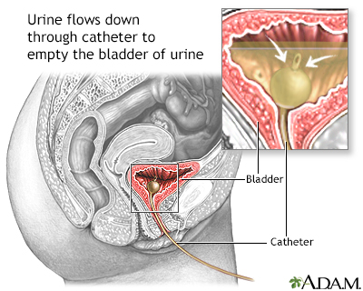 Bladder catheterization - female - Illustration Thumbnail
              