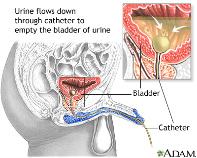 Traumatic injury of the bladder and urethra Information