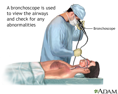 Bronchoscopy