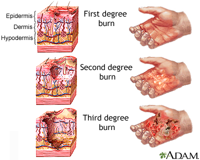 Sunburn Information Mount Sinai New York