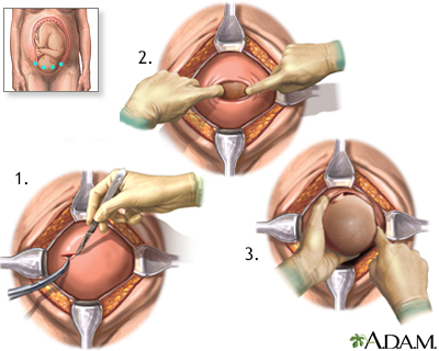 Cesarean section - Illustration Thumbnail
              