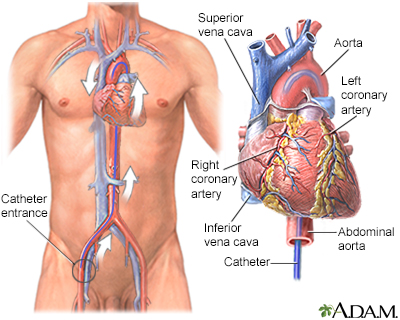 Cardiac catheterization - Illustration Thumbnail
              