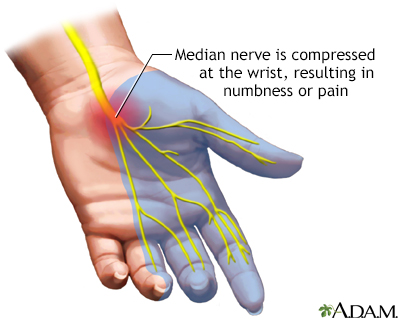 Carpal tunnel syndrome - Illustration Thumbnail
                      