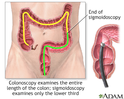 Ulcerative Colitis - Symptoms and Causes