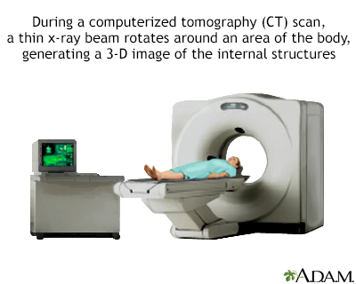 CT scan - Illustration Thumbnail
                      