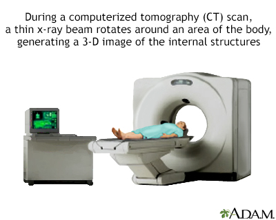 CT scan or CAT scan: How does it work?