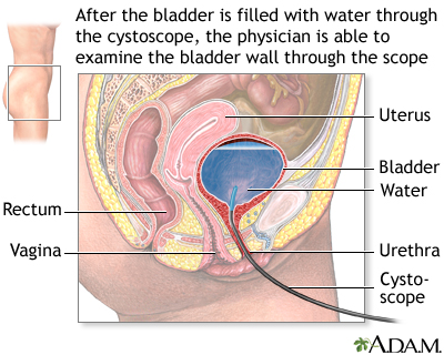 Stress urinary incontinence Information