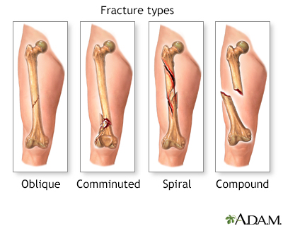 Understanding the Different Types of Bone Fractures