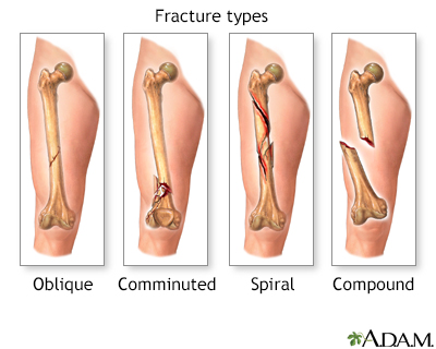 broken bones out of skin real