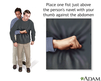 Heimlich maneuver on adult - Illustration Thumbnail
              