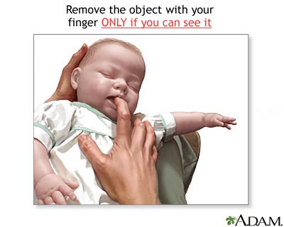Heimlich maneuver on infant - Illustration Thumbnail
              