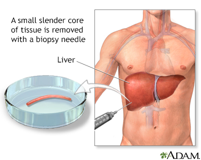 liver biopsy needle