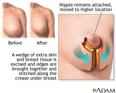 Breast reduction Information