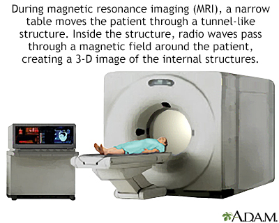 forvisning ekko ugunstige Magnetic resonance angiography Information | Mount Sinai - New York