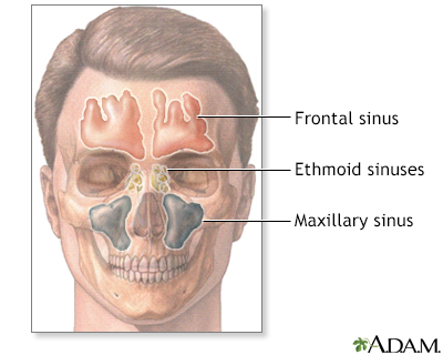 Sinusitis Information Mount Sinai New York