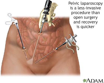 Laparoscopie pelvienne