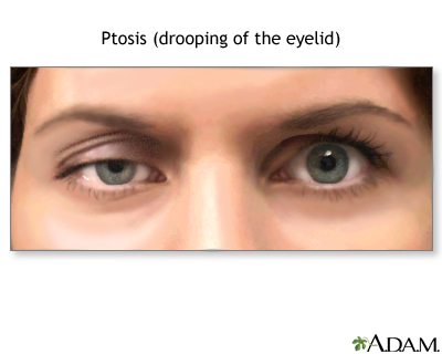 drooping of upper eyelid