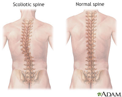 Spinal fusion Information