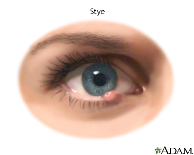 Stye on the Eyelid: Causes, Treatment, and More