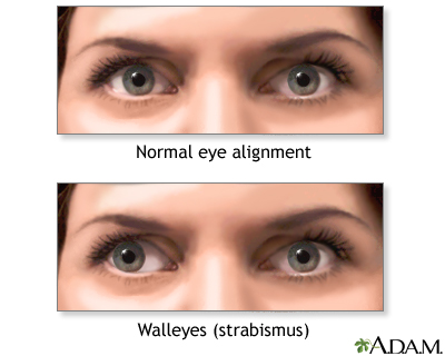 Strabismus: A condition of being wall-eyed or cross-eyed