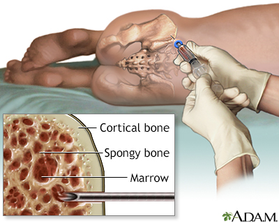 Bone marrow aspiration - Illustration Thumbnail
              