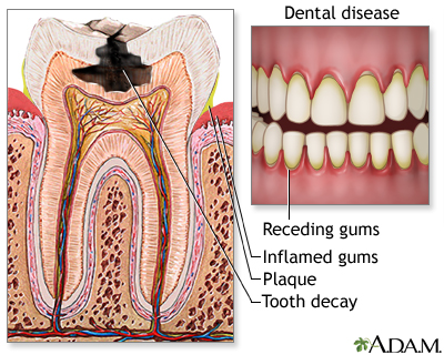 Aging changes in teeth and gums Information