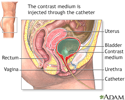 Voiding cystourethrogram - Illustration Thumbnail              