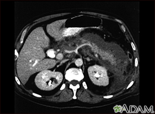 Pancreatitis, acute - CT scan - Illustration Thumbnail
                      