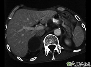 Adrenal metastases - CT scan - Illustration Thumbnail
                      