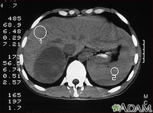 Adrenocortical Cancer (ACC) - INCA